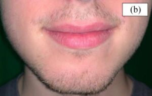 A set of twins, one of which used Minoxidil for 16 weeks