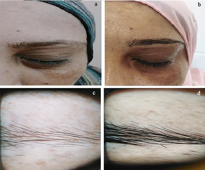 Before and after minoxidil for eyebrows Patient’s eyebrows before (a, c) and after (b,d) 16 weeks of minoxidil 2% treatment (Zaky et al, 2023)[Source & image credit: 7]