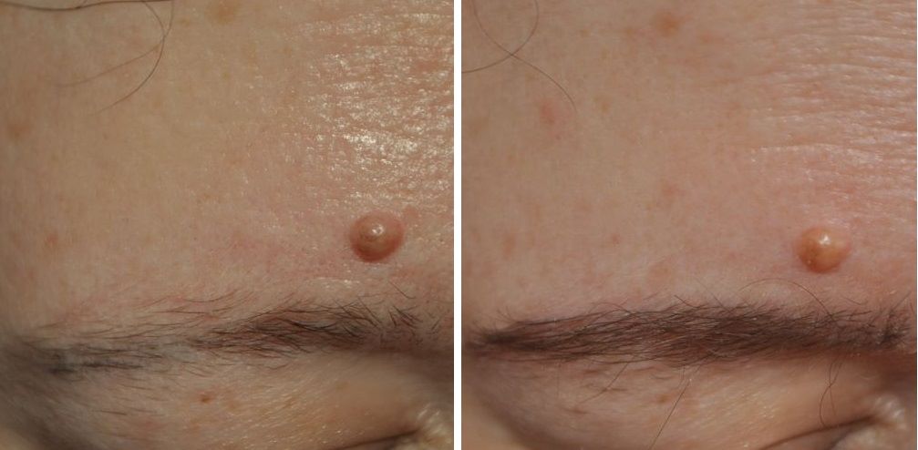 Patient before and after eyebrow transplant