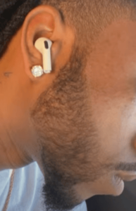 Man before, 3 and 4 months into minoxidil beard treatment