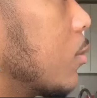 Man before and after minoxidil beard treatment