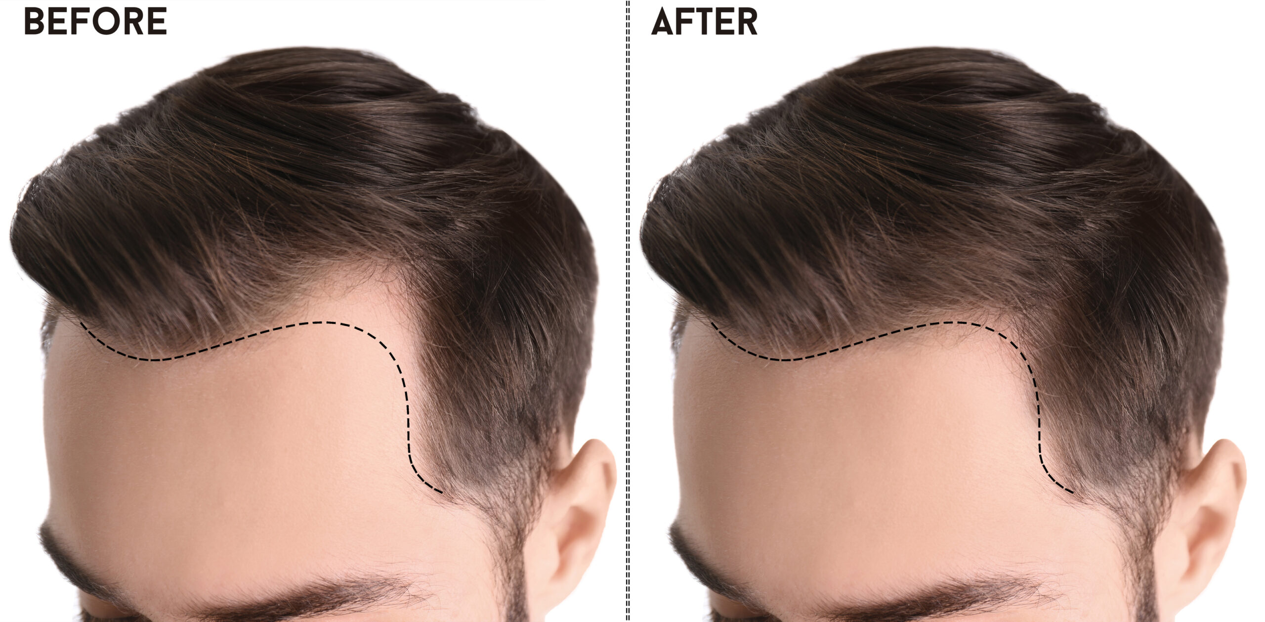 Patient before and after a hair transplant