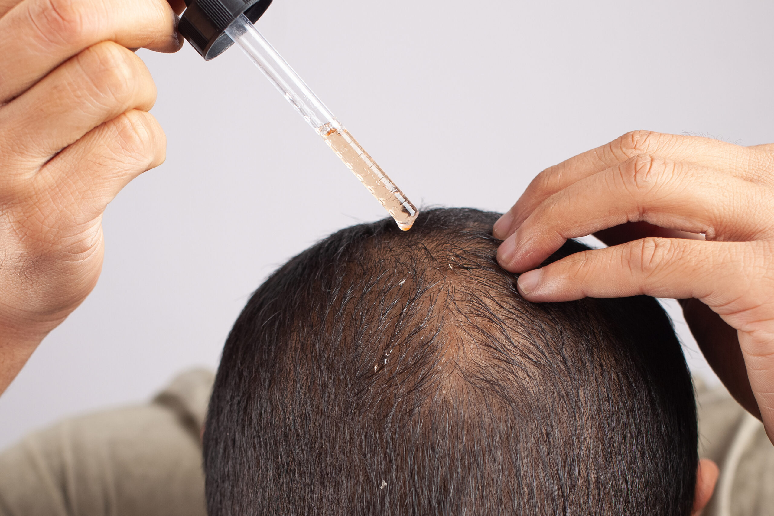 man using minoxidil