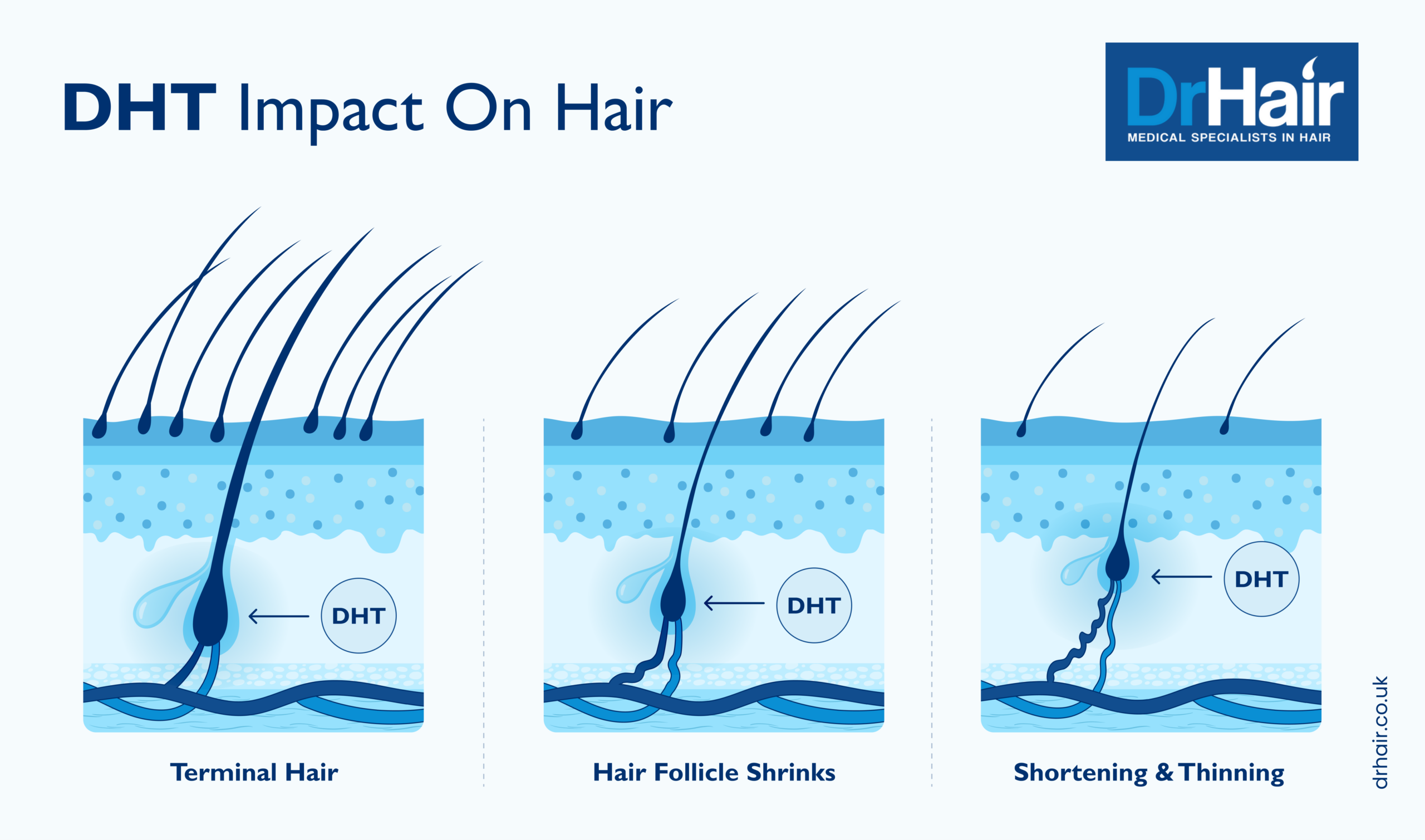 DHT’s impact on hair follicles.