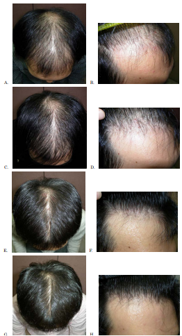 Image series showing finasteride results over 5 years. Source: [11].