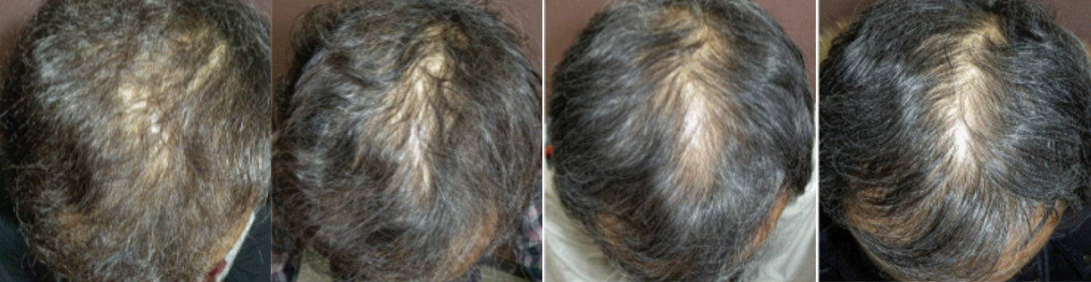 Image source: [1]. From left to right on the top row we see year 2 of treatment, year 3, 4 and 5. From left to right, on the bottom, we see year 6, 7, 8, and 9. 